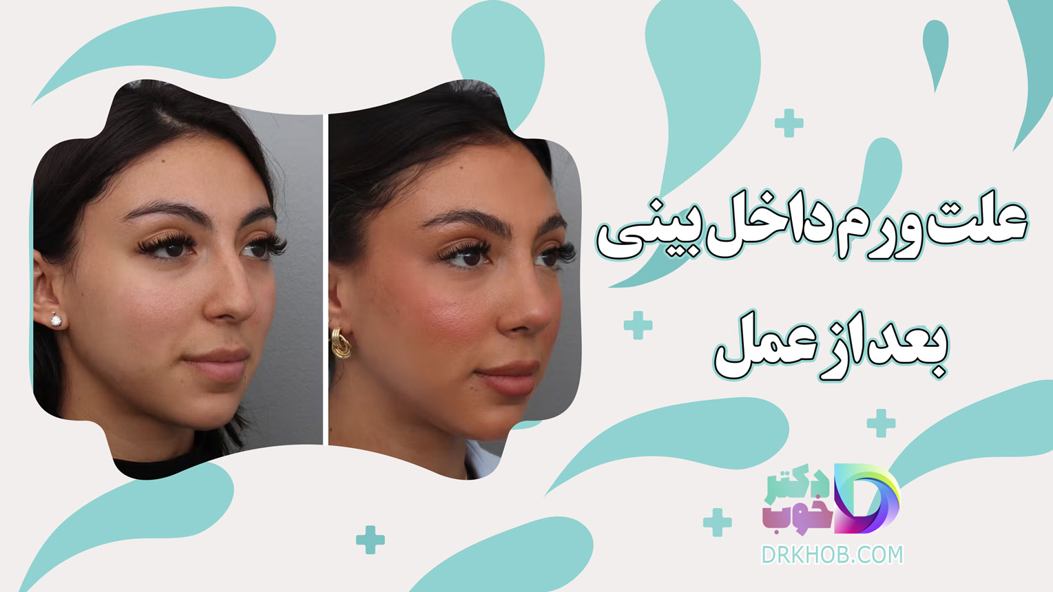 علت ورم داخل بینی بعد عمل