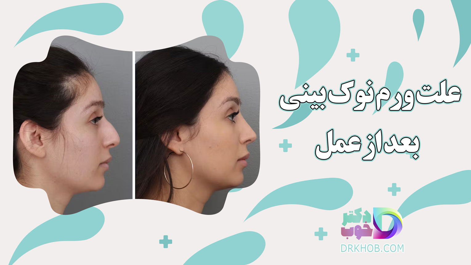 علت ورم نوک بینی بعد از عمل