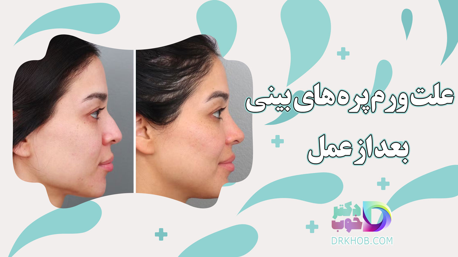 علت ورم پره های بینی بعد از عمل