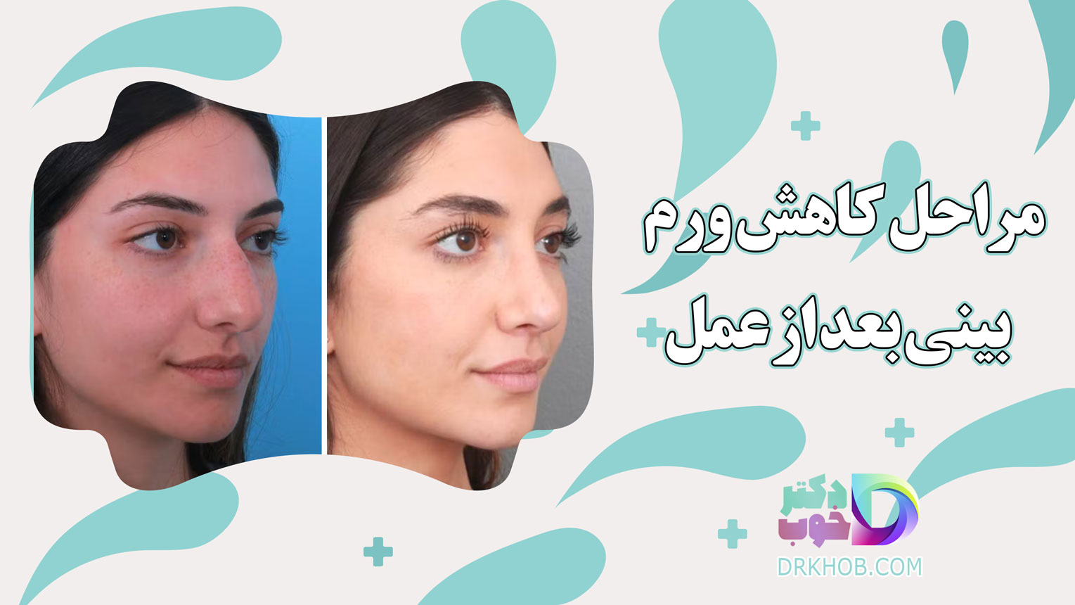 مراحل کاهش ورم بینی بعد از عمل