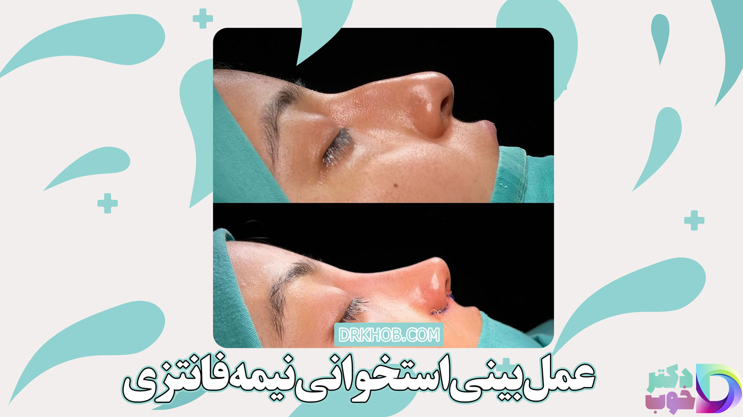 عمل بینی استخوانی نیمه فانتزی