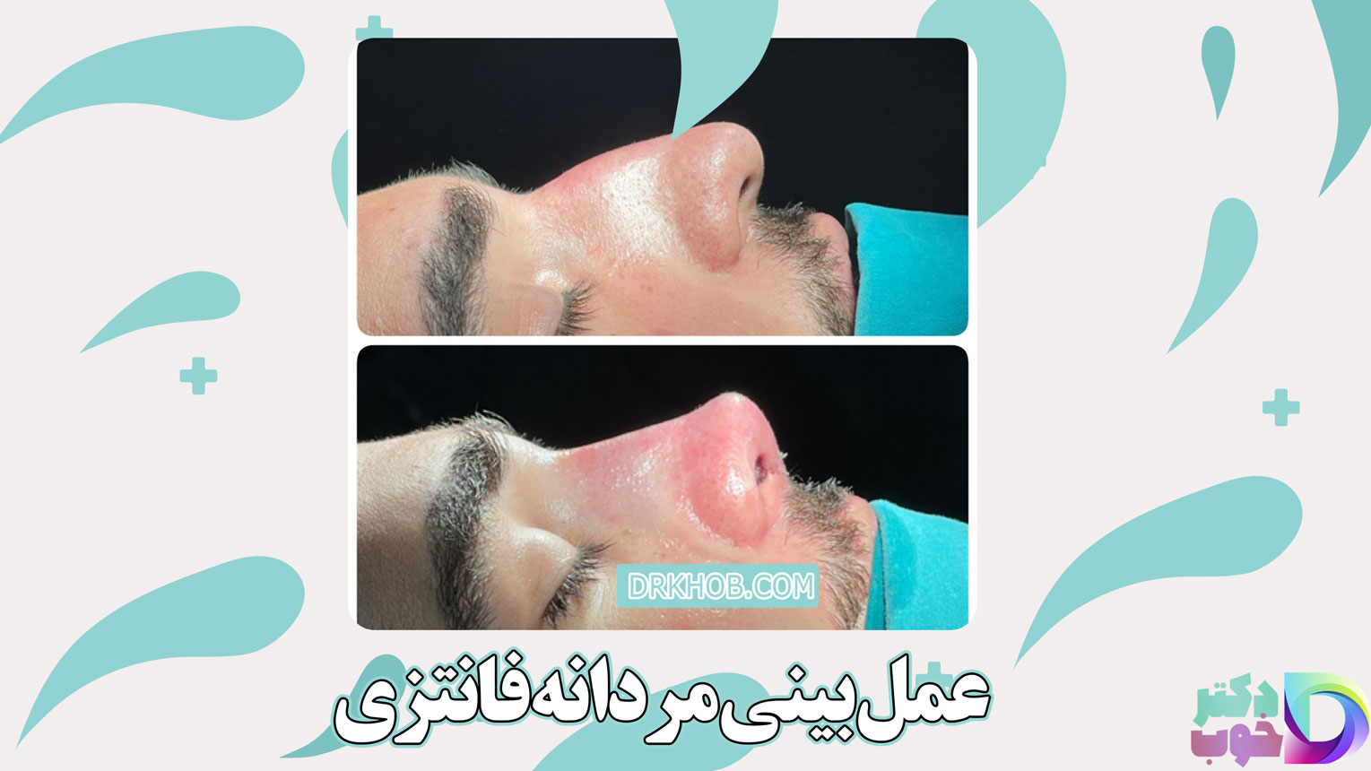 عمل بینی مردانه فانتزی