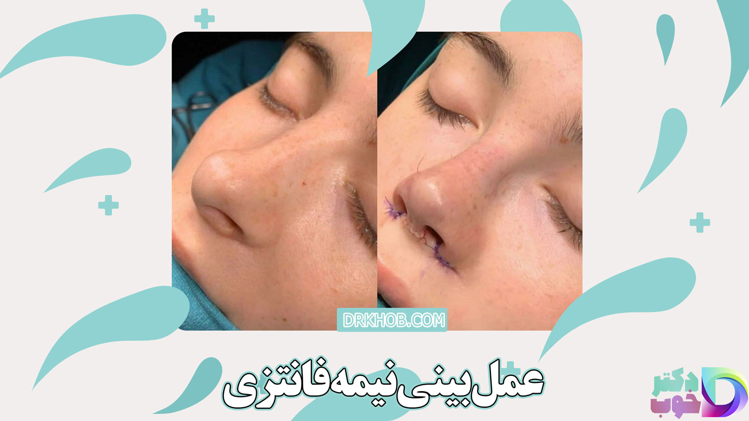عمل بینی نیمه فانتزی