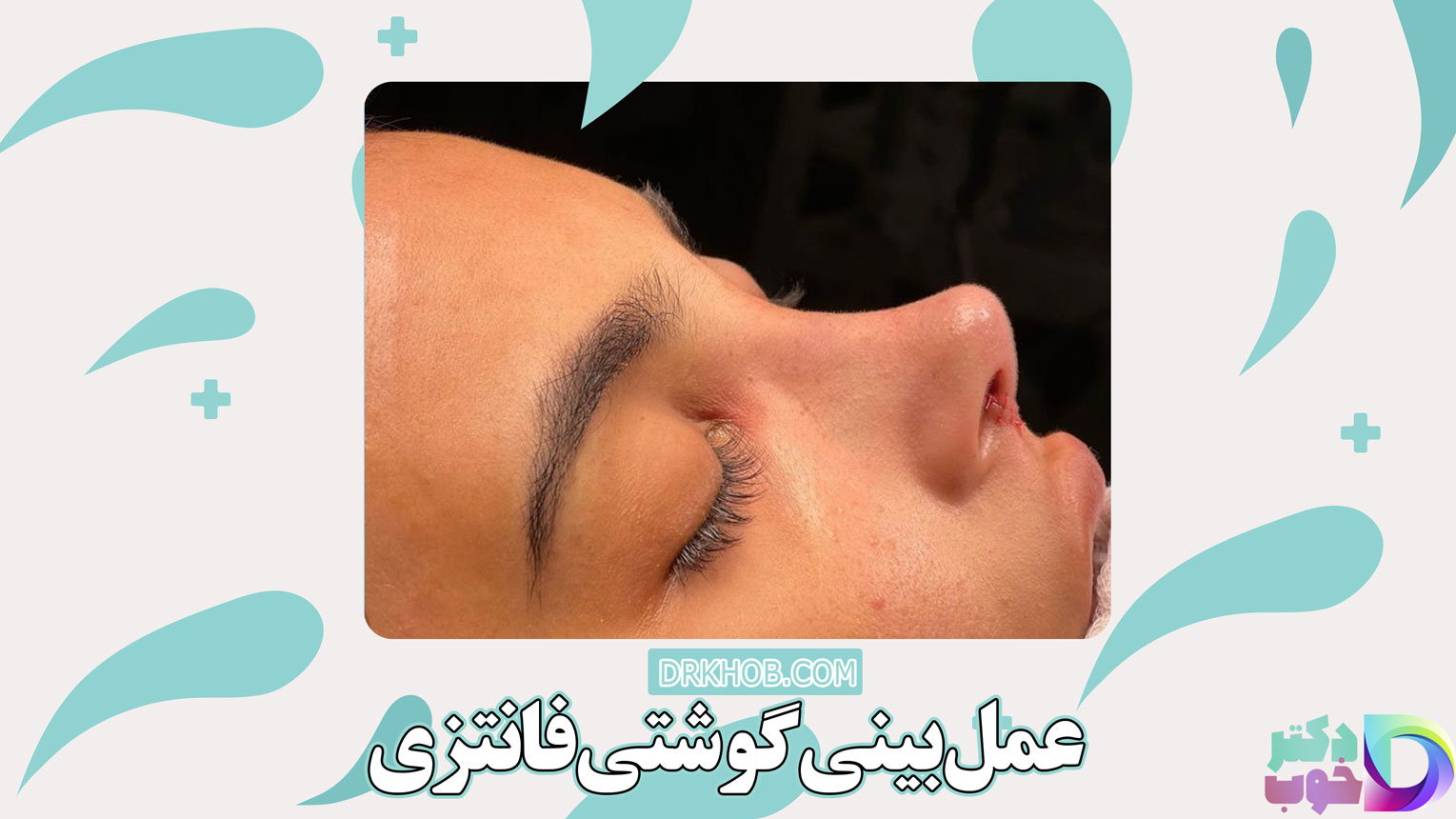عمل بینی گوشتی فانتزی